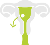 Embryo Failure
